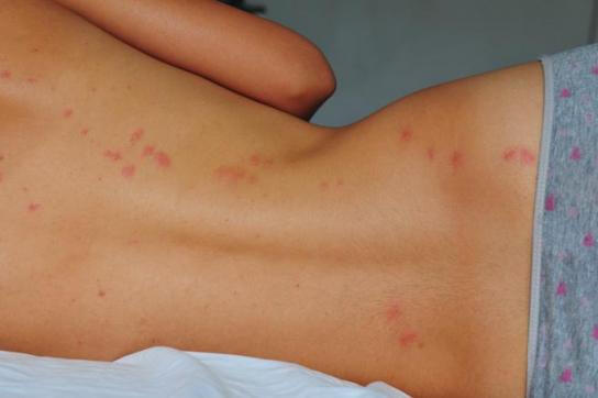 picaduras chinches madrid